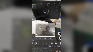 Sistema de diagnóstico de ultrassom Doppler colorido com carrinho BR-US01